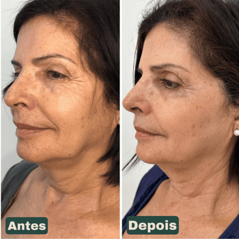 CollageSkin – Máscara Anti-idade com Efeito Lifting - Image 4
