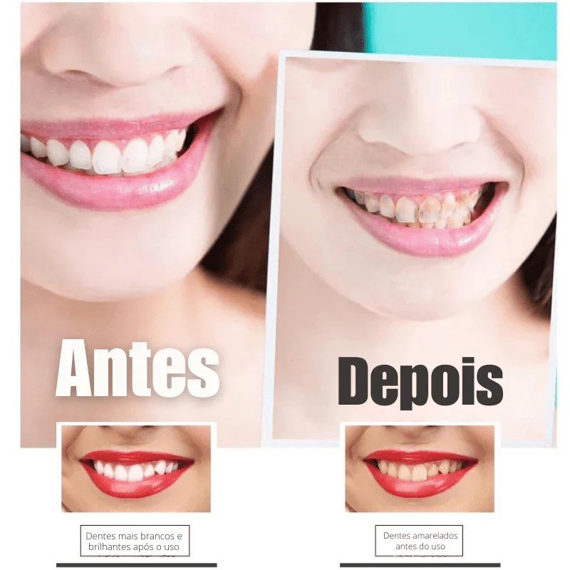 SmileKit – Clareamento total em 30 minutos - Image 7
